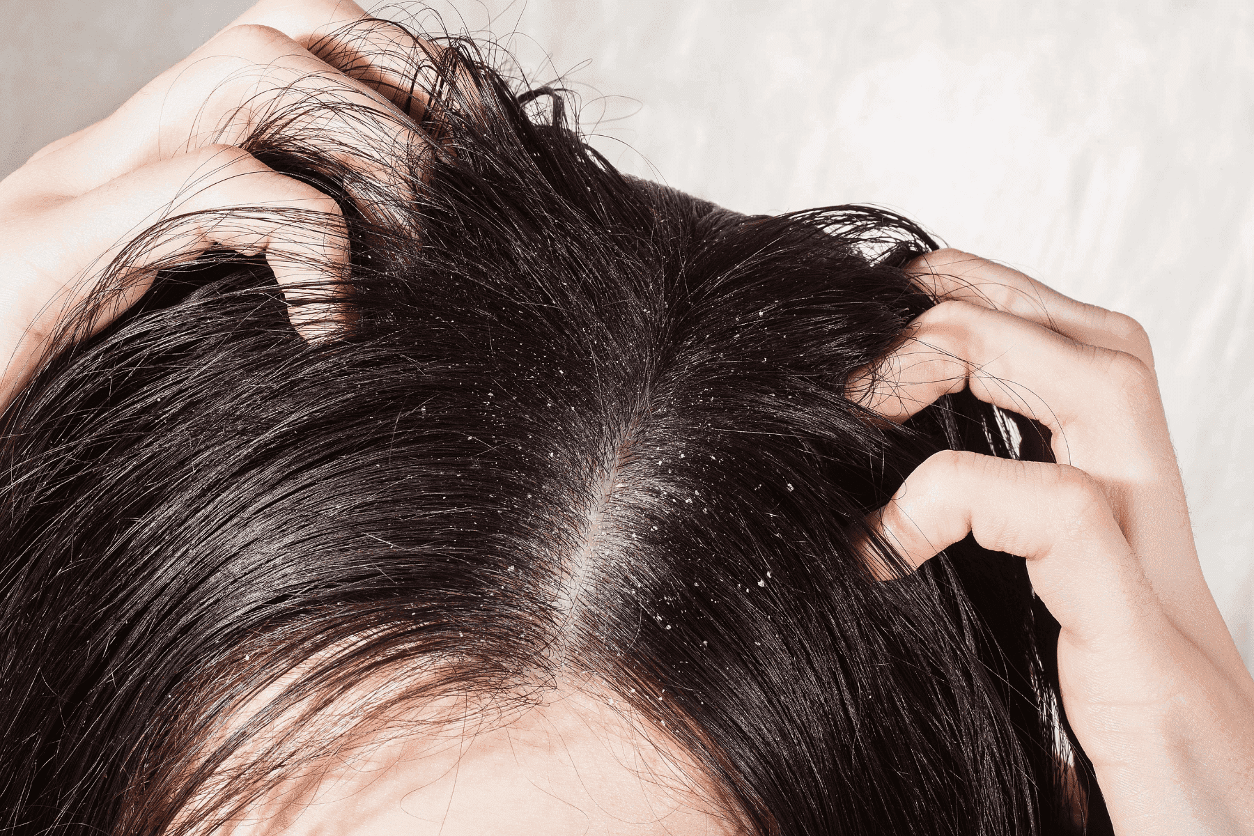 Problemzone Kopfhaut: Welche Faktoren deine Kopfhaut austrocknen